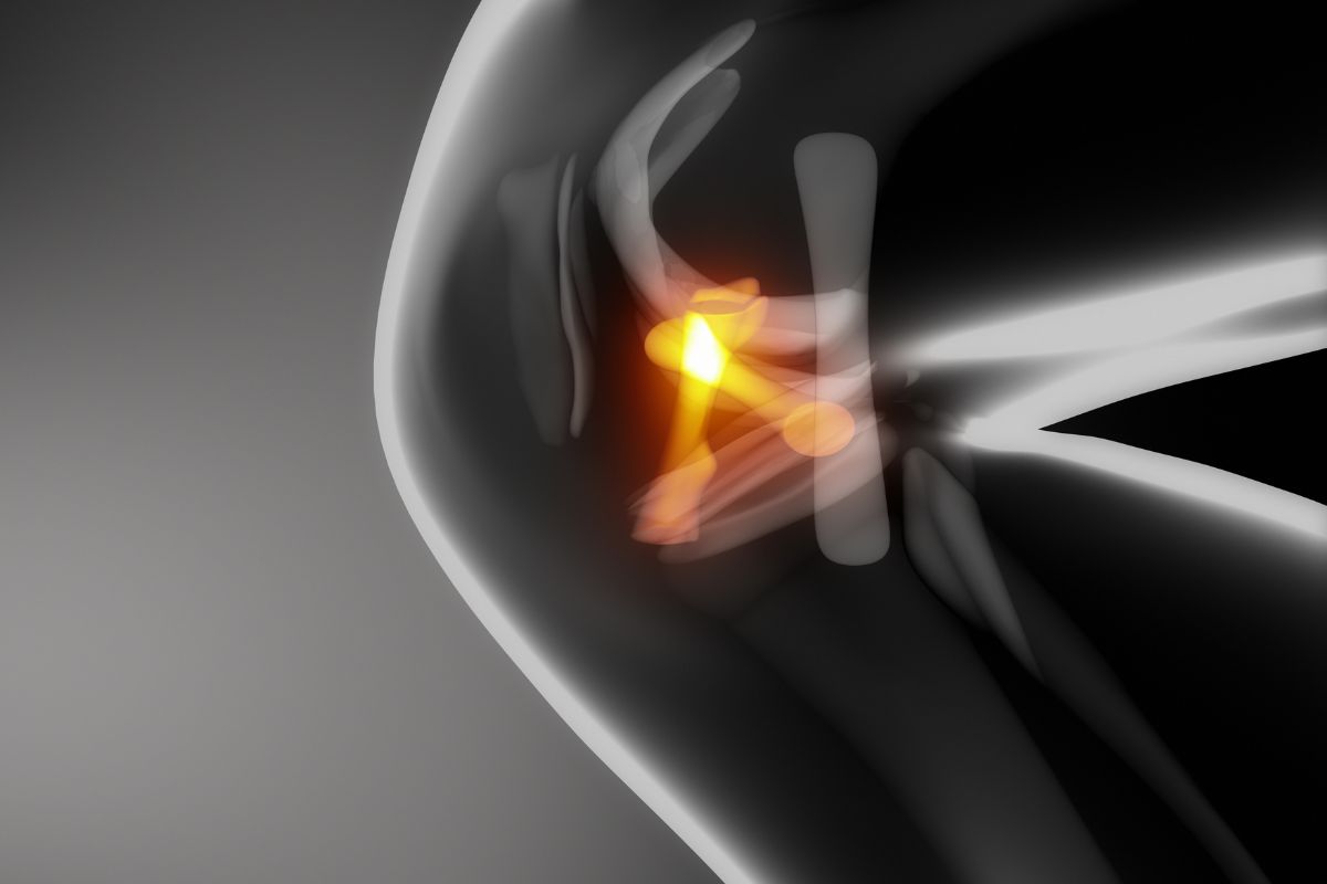 lesao-ligamento-cruzado-posterior-dr-lucas-cordeiro-ortopedista-cirurgiao-joelho-sao-paulo