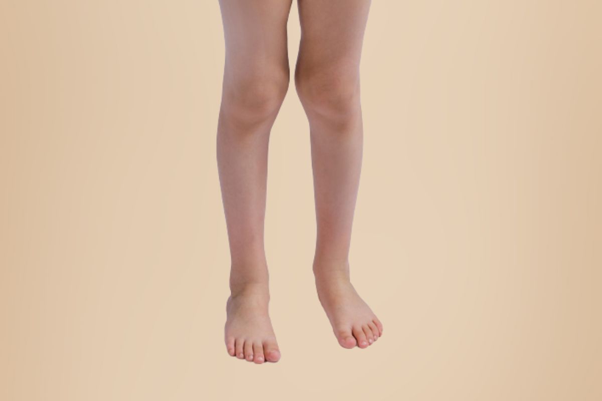 Leia mais sobre o artigo Como corrigir joelho valgo?