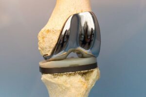 protese-total-de-joelho-dr-lucas-cordeiro-ortopedista-joelho-sao-paulo